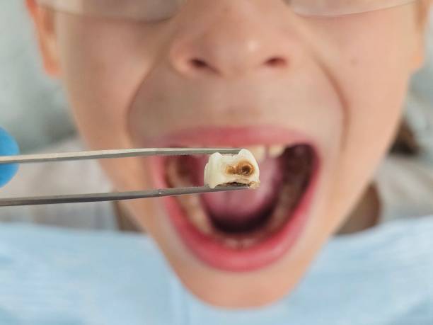 Best Emergency Dental Care for Broken or Chipped Teeth in Moreno Valley, CA